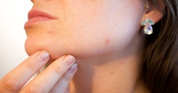 Bien Magazine advises how laser treatment can help with dark spots